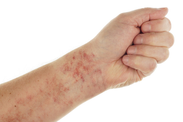 image of an arm and skin rash and home heating ands cooling system