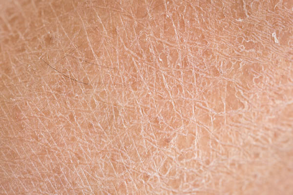 image of dry skin due to indoor air quality and hvac system