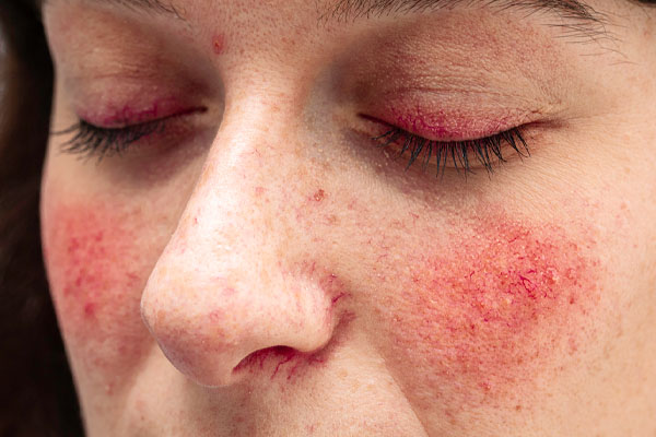 image of rosacea and hvac and skin issues